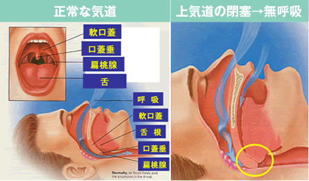 SASの原因・症状