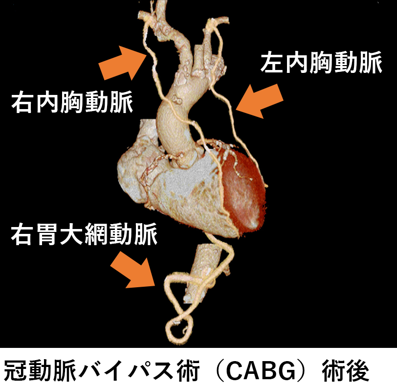 冠動脈バイパス術(CABG)術後