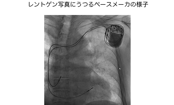 PCIの治療前の心臓の写真入る