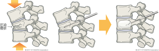 骨粗鬆症性脊椎椎体骨折