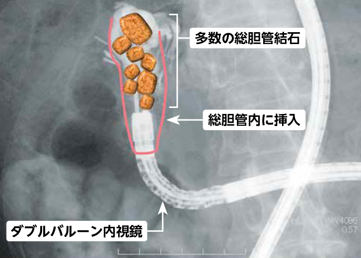 ルーワイ再建を行った人の総胆管結石を、ダブルバルーン内視鏡下ERCPで映し出した様子