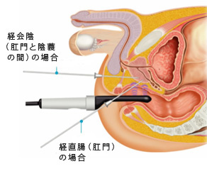 経直腸的超音波検査+前立腺針生検